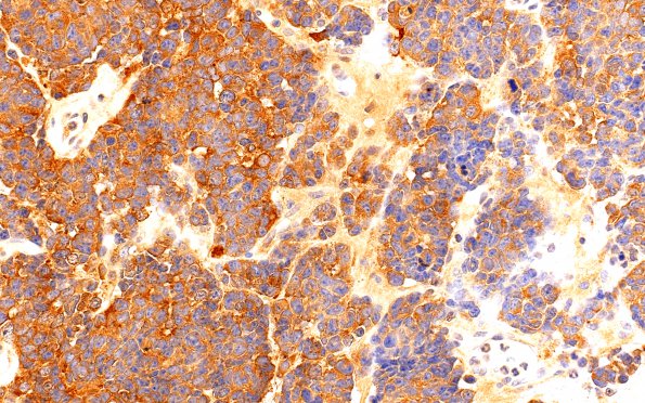 10C Pineoblastoma (Case 10) NSE 40X