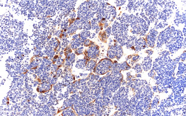 10D2 Pineoblastoma (Case 10) S100 20X