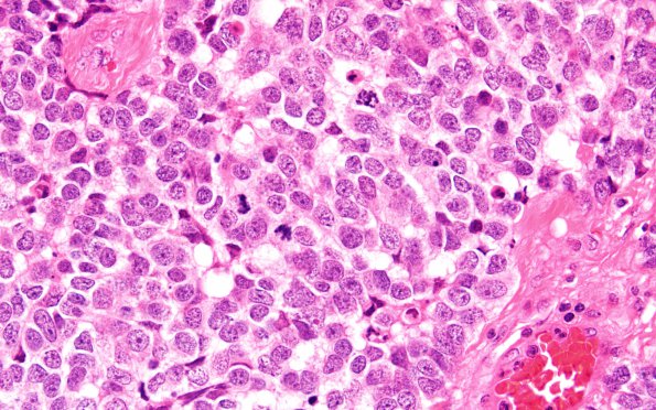 11A3 (Case 11) H&E 60X