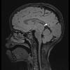 1A1 Pineoblastoma (Case 1) FLAIR 1 copy - Copy