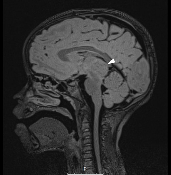 1A1 Pineoblastoma (Case 1) FLAIR 1 copy - Copy