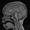 1A2 Pineoblastoma (Case 1) T1 noC sag 1 - Copy