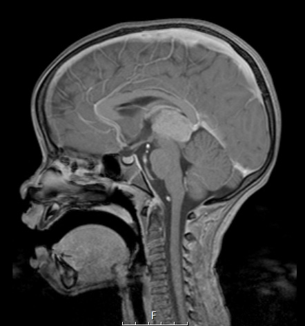 1A3 Pineoblastoma (Case 1) T1W sag 1 - Copy