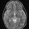 1A4 Pineoblastoma (Case 1) T2 W 1 - Copy