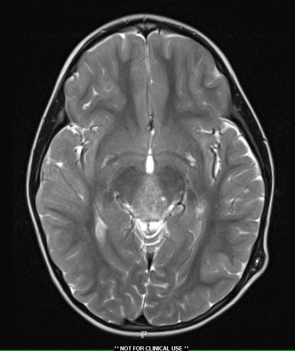 1A4 Pineoblastoma (Case 1) T2 W 1 - Copy