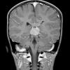 1A5 Pineoblastoma (Case 1) T1 W2 - Copy