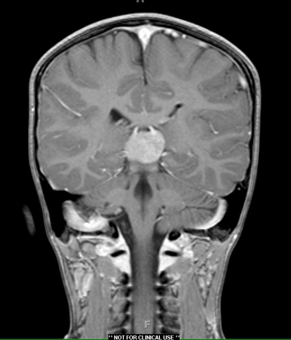 1A5 Pineoblastoma (Case 1) T1 W2 - Copy