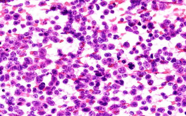 1B1 Pineoblastoma (Case 1) H&E 60X