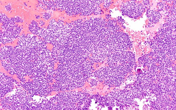 1B2 Pineoblastoma (Case 1) H&E 2