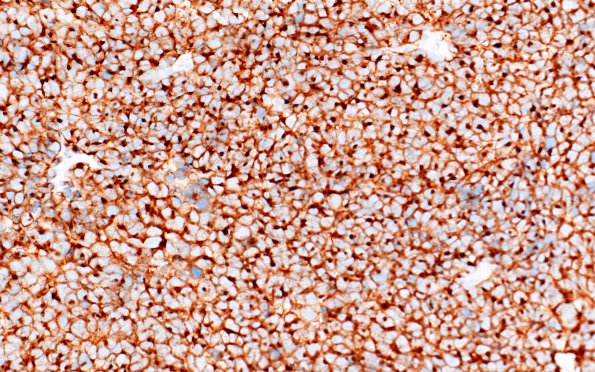 1C1 Pineoblastoma (Case 1) SYN 2