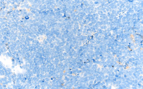 1E Pineoblastoma (Case 1) NeuN 40X