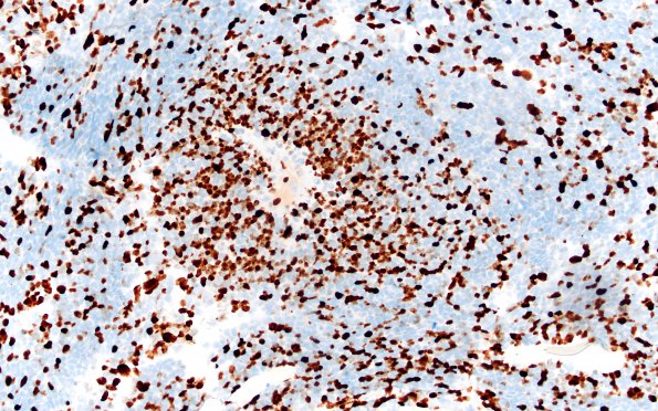 1H2 Pineoblastoma (Case 1) Ki67 20X