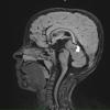 2A1 Pineoblastoma (Case 2) FLAIR - Copy