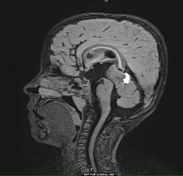 2A1 Pineoblastoma (Case 2) FLAIR - Copy