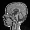 2A2 Pineoblastoma (Case 2) T1 no contrast - Copy