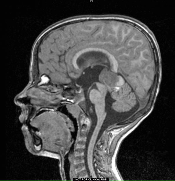 2A2 Pineoblastoma (Case 2) T1 no contrast - Copy