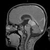 2A3 Pineoblastoma (Case 2) T1 with contrast 2 - Copy