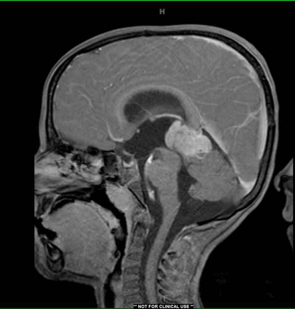 2A3 Pineoblastoma (Case 2) T1 with contrast 2 - Copy