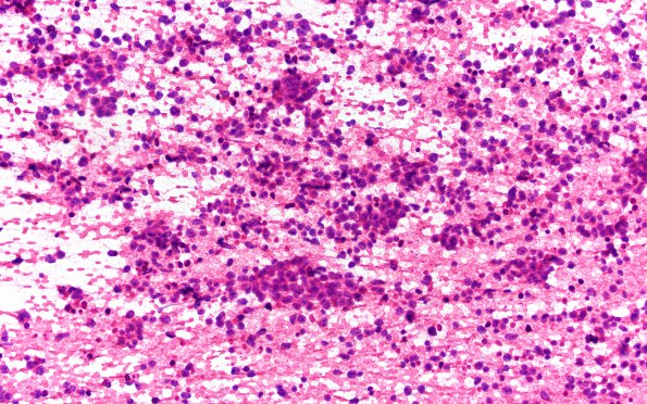 2B1 Pineoblastoma (Case 2) H&E smear 40X