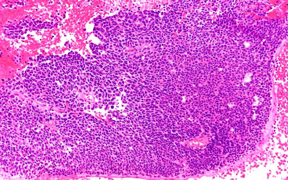 2B2 Pineoblastoma (Case 2) H&E 20X 1