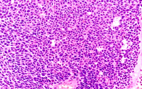 2B3 Pineoblastoma (Case 2) H&E 40X 1