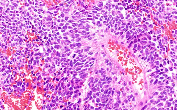 2B4 Pineoblastoma (Case 2) H&E 2