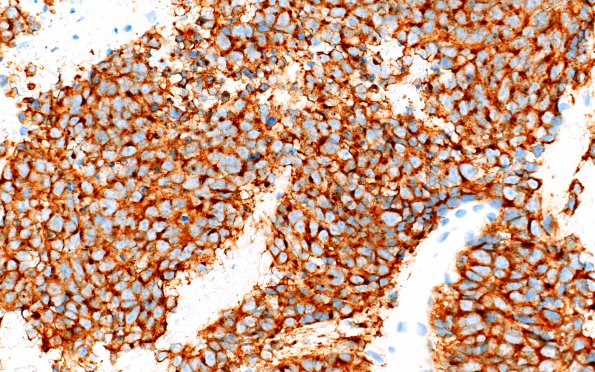 2C1 Pineoblastoma (Case 2) SYN 40X