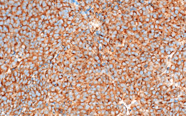 2C2 Pineoblastoma (Case 2) SYN 2