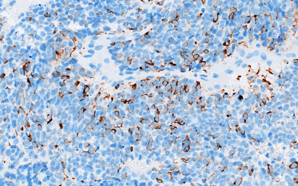 2D1 Pineoblastoma (Case 2) NF 1