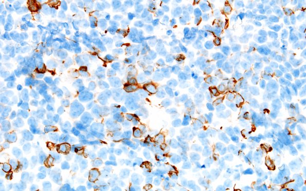 2D2 Pineoblastoma (Case 2) NF 60X