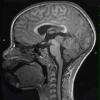 3A1 Pineoblastoma (Case 3) MPRAGE 1 - Copy