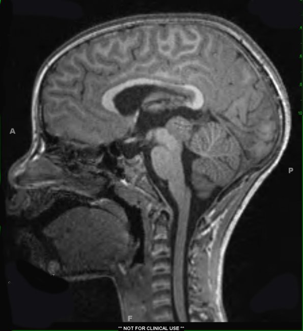 3A1 Pineoblastoma (Case 3) MPRAGE 1 - Copy