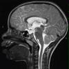 3A2 Pineoblastoma (Case 3) T2 - Copy