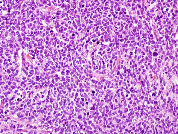 3B1 Pineoblastoma (Case 3) H&E 1