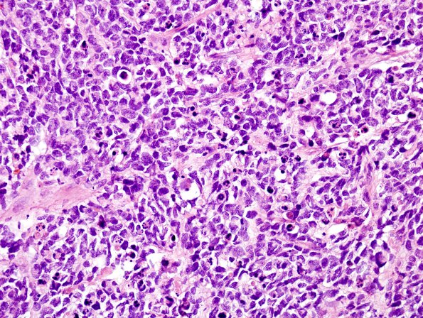 3B2 Pineoblastoma (Case 3) H&E 2