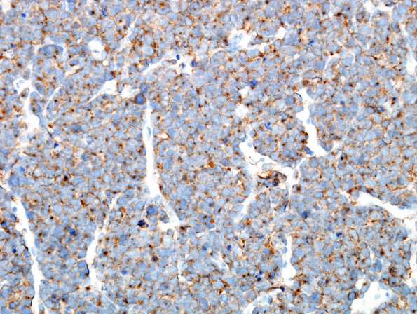 3C1 Pineoblastoma (Case 3) SYN 2