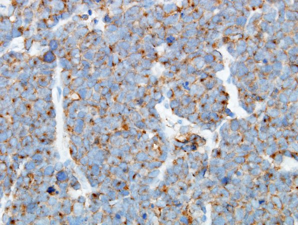 3C2 Pineoblastoma (Case 3) SYN 1