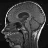 4A1 Pineoblastoma (Case 4) T1 3 - Copy