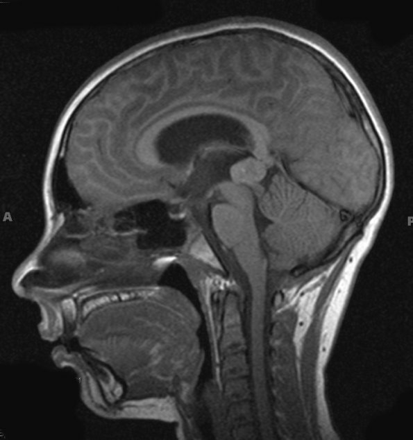 4A1 Pineoblastoma (Case 4) T1 3 - Copy