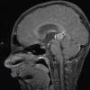 4A2 Pineoblastoma (Case 4) T1 W 2 - Copy