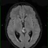 4A3 Pineoblastoma (Case 4) FLAIR 1 - Copy