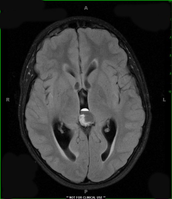 4A3 Pineoblastoma (Case 4) FLAIR 1 - Copy