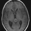 4A4 Pineoblastoma (Case 4) T1 - Copy