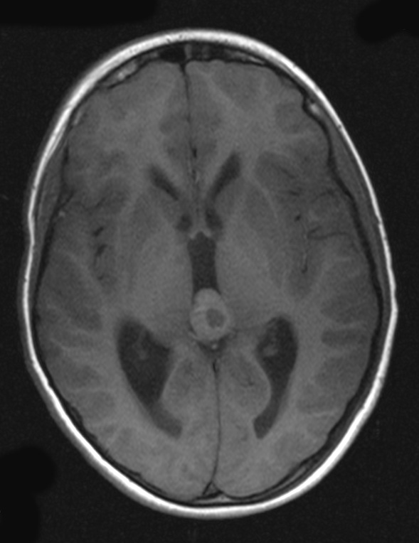 4A4 Pineoblastoma (Case 4) T1 - Copy