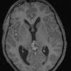 4A5 Pineoblastoma (Case 4) T1 W 4 - Copy