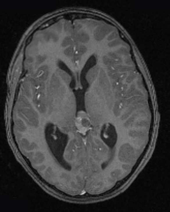 4A5 Pineoblastoma (Case 4) T1 W 4 - Copy