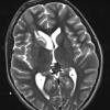 4A6 Pineoblastoma (Case 4) T2 1 - Copy