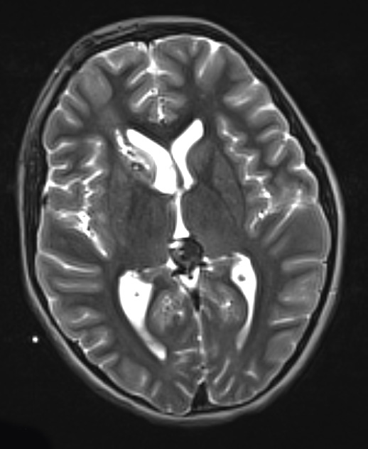 4A6 Pineoblastoma (Case 4) T2 1 - Copy