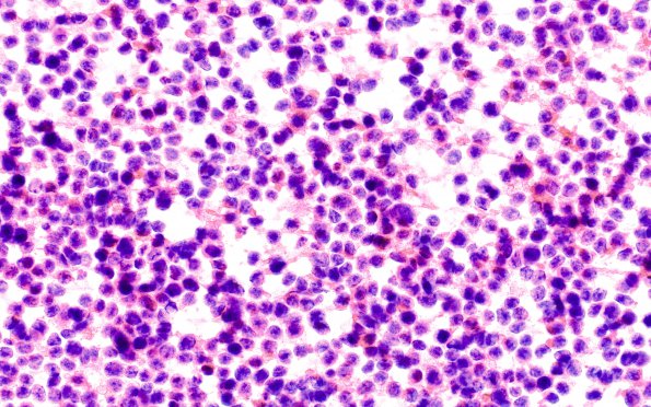 4B1 Pineoblastoma (Case 4) H&E smear 40X