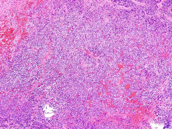 4B2 Pineoblastoma (Case 4) H&E 5.jpg